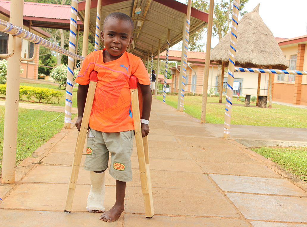 Casts to Make a Clubfoot Straight 